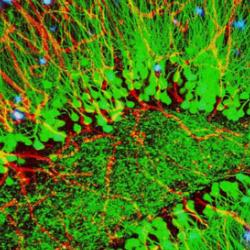 Brain showing hallmarks of Alzheimer's disease (plaques in blue)