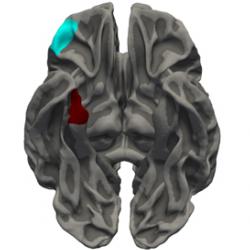 The orbitofrontal cortex (blue) and medial temporal cortex (red) were more similar in terms of thickness in youths with Conduct Disorder than in typically-developing youths, suggesting that the normal pattern of brain development is disrupted.