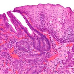 Image of an oesophageal carcinoma 
