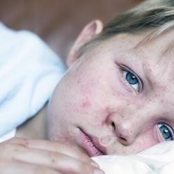 Very sick 5 year old little boy fighting measles infection, boy is laying in bed under the blanket with an agonizing expression, boy is covered with rash caused by virus.