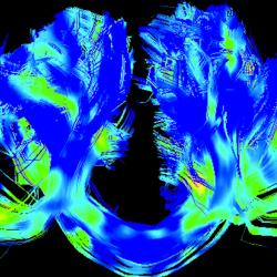 Corpus callosum, left-right connections, in a Parkinson's brain