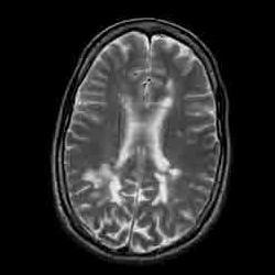 MRI showing lesions on the brain